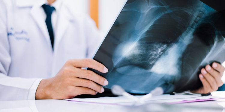 El cáncer de pulmón suele diagnosticarse en una etapa avanzada