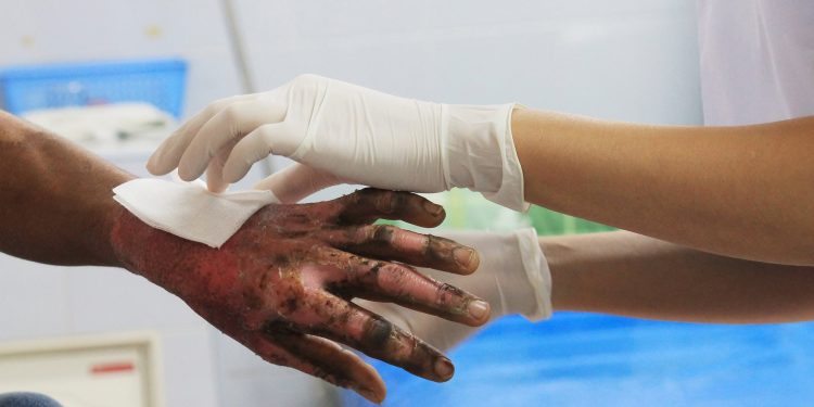 Joven de 24 años en Soledad es el primer quemado con pólvora en Atlántico