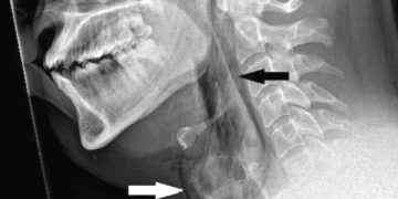 ¡Increíble! Hombre evitó estornudar y se desgarró la tráquea