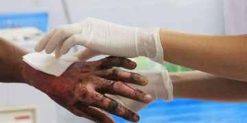 Menor de 13 años resultó quemado con pólvora durante la celebración de velitas, en Las Gardenias
