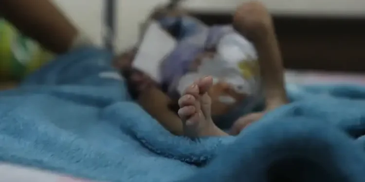 Alarmante aumento de mortalidad infantil por desnutrición aguda en Colombia en 2023: Más de 200 niños perdieron la vida