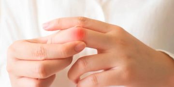 Lupus: “entendiendo la enfermedad y aprendiendo a vivir con ella”