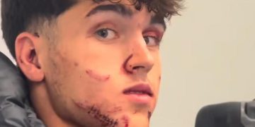 Pau Cubarsí central del barça abandonó el terreno sangrando tras dura entrada en el rostro