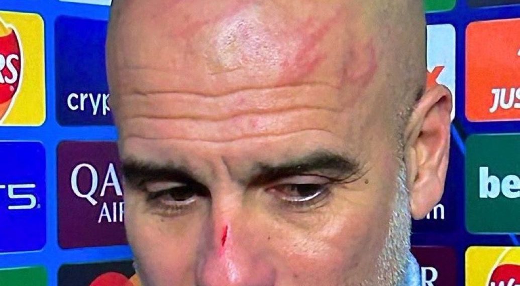 Guardiola apareció con lesiones tras el empate que sufrió el City luego de ir ganando 3-0