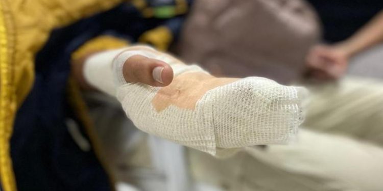 Barranquilla reporta intoxicación por fósforo blanco y quemaduras en la Noche de Velitas