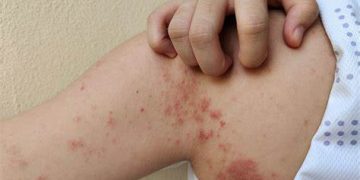 Alertan por casos de lepra reportados en varios municipios del Magdalena