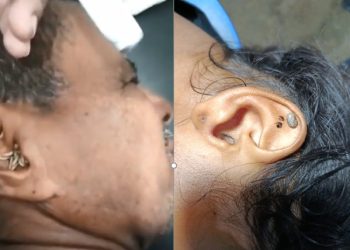 Dos casos inusuales en Sabanalarga: médico extrae garrapatas y gusanos de oídos humanos