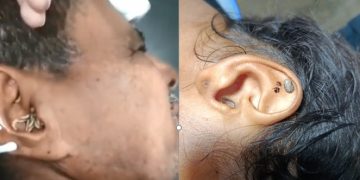 Dos casos inusuales en Sabanalarga: médico extrae garrapatas y gusanos de oídos humanos