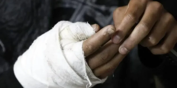 Atlántico registra cinco quemados por pólvora en diciembre: dos menores entre los afectados, según el INS