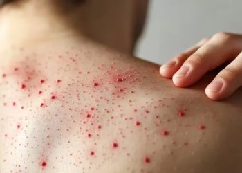 Colombia confirma cuarto caso importado de sarampión