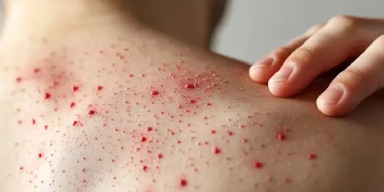 Colombia confirma cuarto caso importado de sarampión